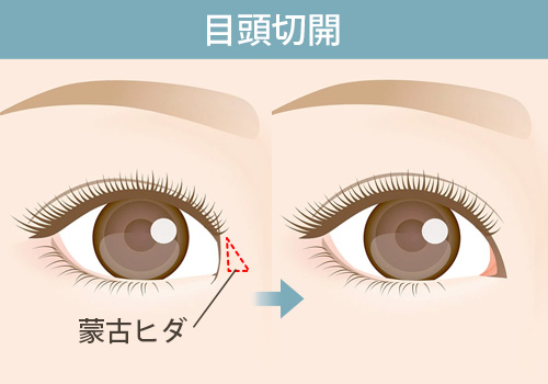 目頭切開とは