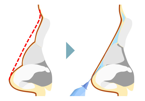 鼻のヒアルロン酸注入とは