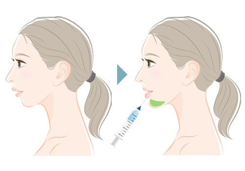 顎プロテーゼ挿入＋口唇ヒアルロン酸注入・脂肪注入