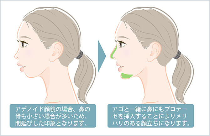 ストア アデノイド顔貌 口テープ