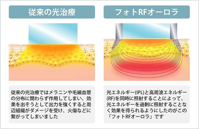 フォトRFオーロラ・リファーム（シミ・シワ・美肌・たるみ） | 美容整形外科のジョウクリニック