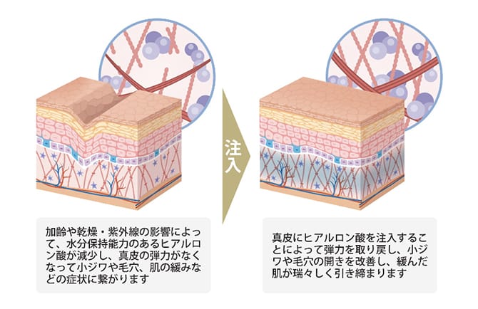 水光注射機（Vital Injector） | 美容整形外科のジョウクリニック