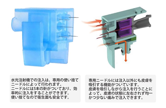 水光注射機（Vital Injector） | 美容整形外科のジョウクリニック