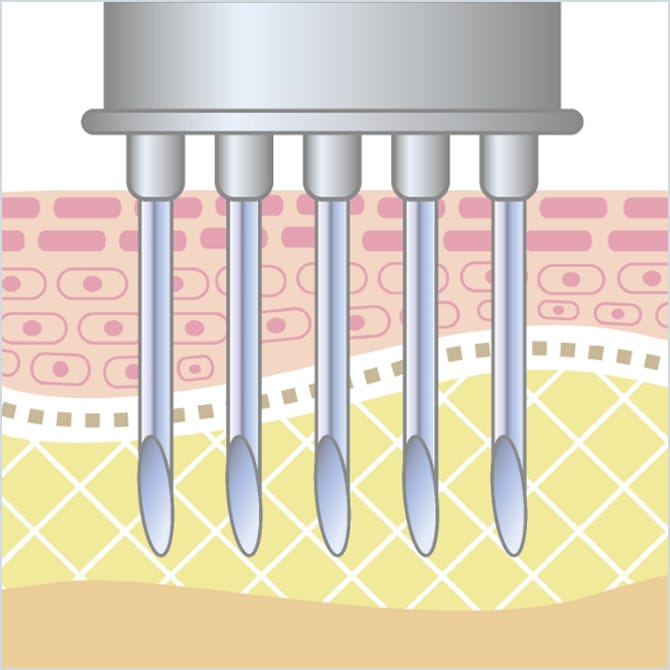 水光注射機（Vital Injector） | 美容整形外科のジョウクリニック