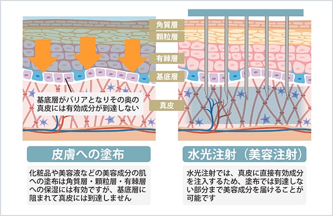 水光注射機（Vital Injector） | 美容整形外科のジョウクリニック