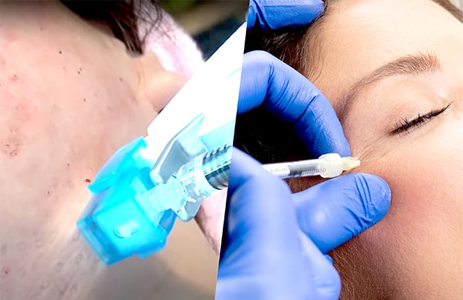 水光注射機（Vital Injector） | 美容整形外科のジョウクリニック