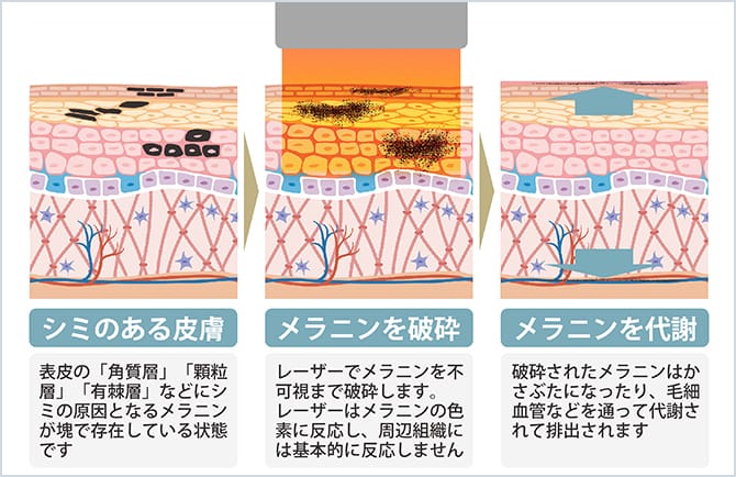 QスイッチYAGレーザー（シミ・アザ・タトゥー除去）| 美容整形外科のジョウクリニック