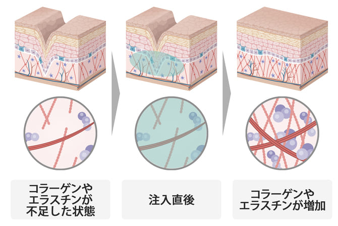 コラーゲンブースター注入 | 美容整形外科のジョウクリニック