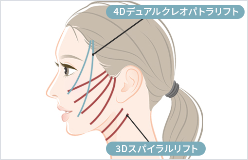 スレッドリフト（糸リフト） | 美容整形外科のジョウクリニック