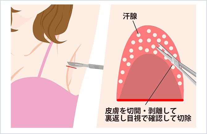 ワキガ手術 皮弁法 剪除法 美容整形外科のジョウクリニック