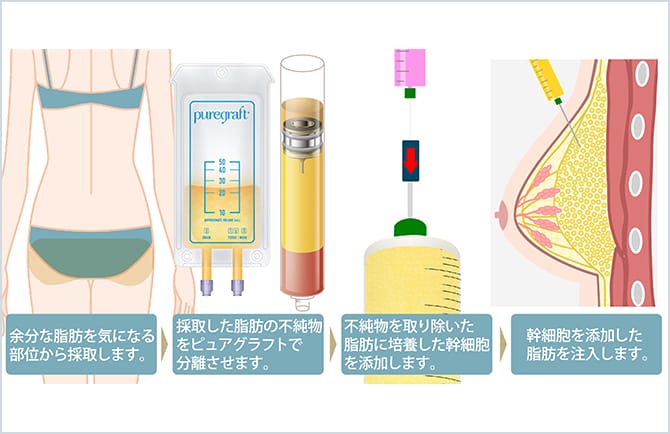 生理食塩バッグ 豊胸 25年 クリアランス