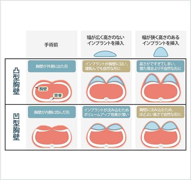 豊 胸 バッグ 種類 ストア