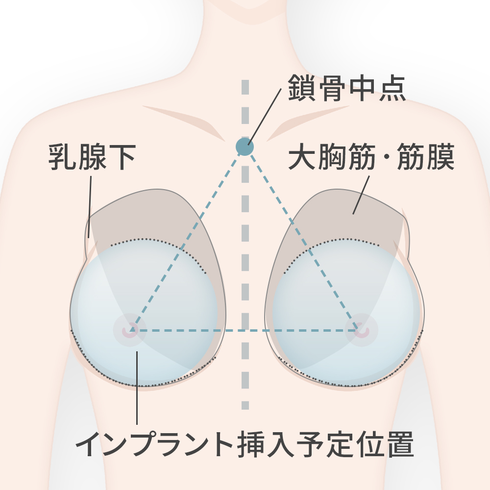 シリコンバッグ豊胸 | 豊胸手術ならジョウクリニック