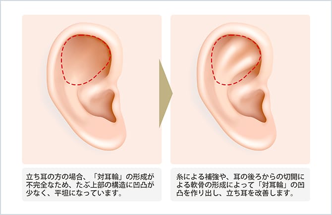 耳の整形 美容整形外科のジョウクリニック