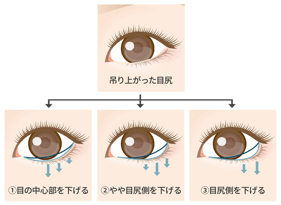 グラマラスライン（たれ目形成・下眼瞼下制術）| 美容整形外科のジョウクリニック