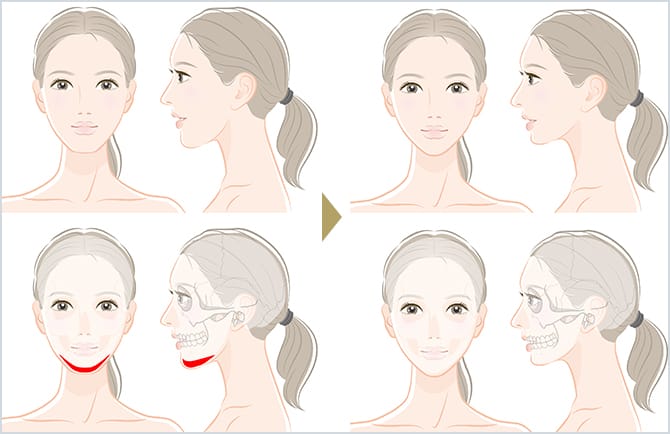 骨削り術（エラ・オトガイ・頬骨削り） | 美容整形外科のジョウクリニック