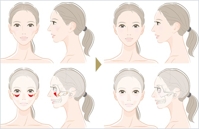 エラ削り オトガイ削り 頬骨削りによる輪郭形成 美容整形外科のジョウクリニック