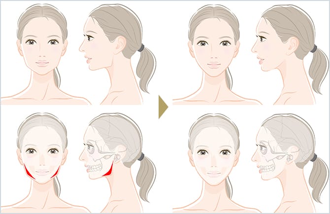 エラ削り オトガイ削り 頬骨削りによる輪郭形成 美容整形外科のジョウクリニック