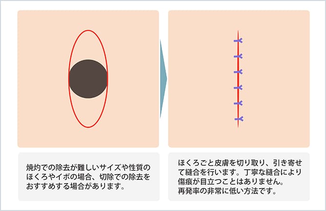 セール ほくろ くりぬき テープ