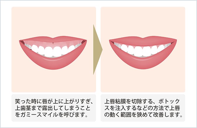 ガミースマイル（上唇粘膜切除術） | 美容整形外科のジョウクリニック