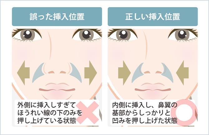 貴族手術 鼻翼基部形成術 鼻の整形ならジョウクリニック