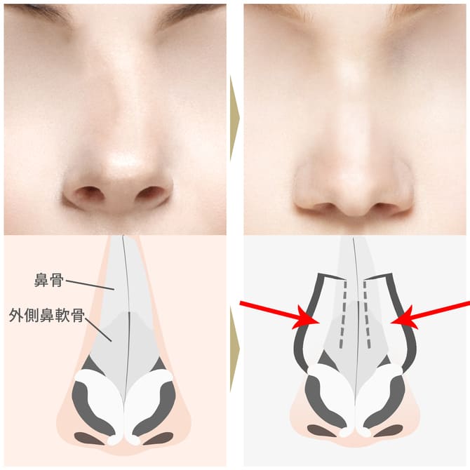 鼻骨骨切り幅寄せ術 鼻の整形ならジョウクリニック