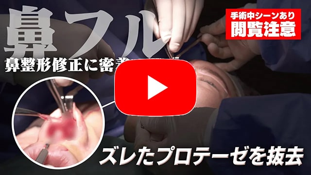 鼻の他院修正に密着する動画