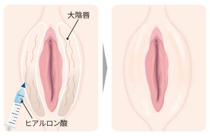 クリアランス 大陰唇クッションの役目