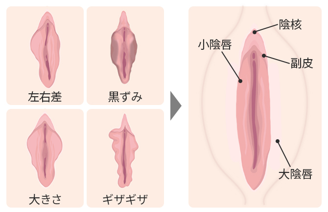 小陰唇縮小術 | 美容整形外科のジョウクリニック