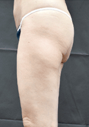 50代女性 下半身 大腿 臀部 脂肪吸引 3ヶ月 後 美容整形外科のジョウクリニック